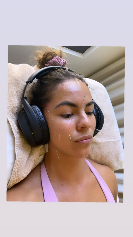 Cosmetic Acupuncture St Kilda: The Rebel’s Guide to Natural Rejuvenation in Melbourne