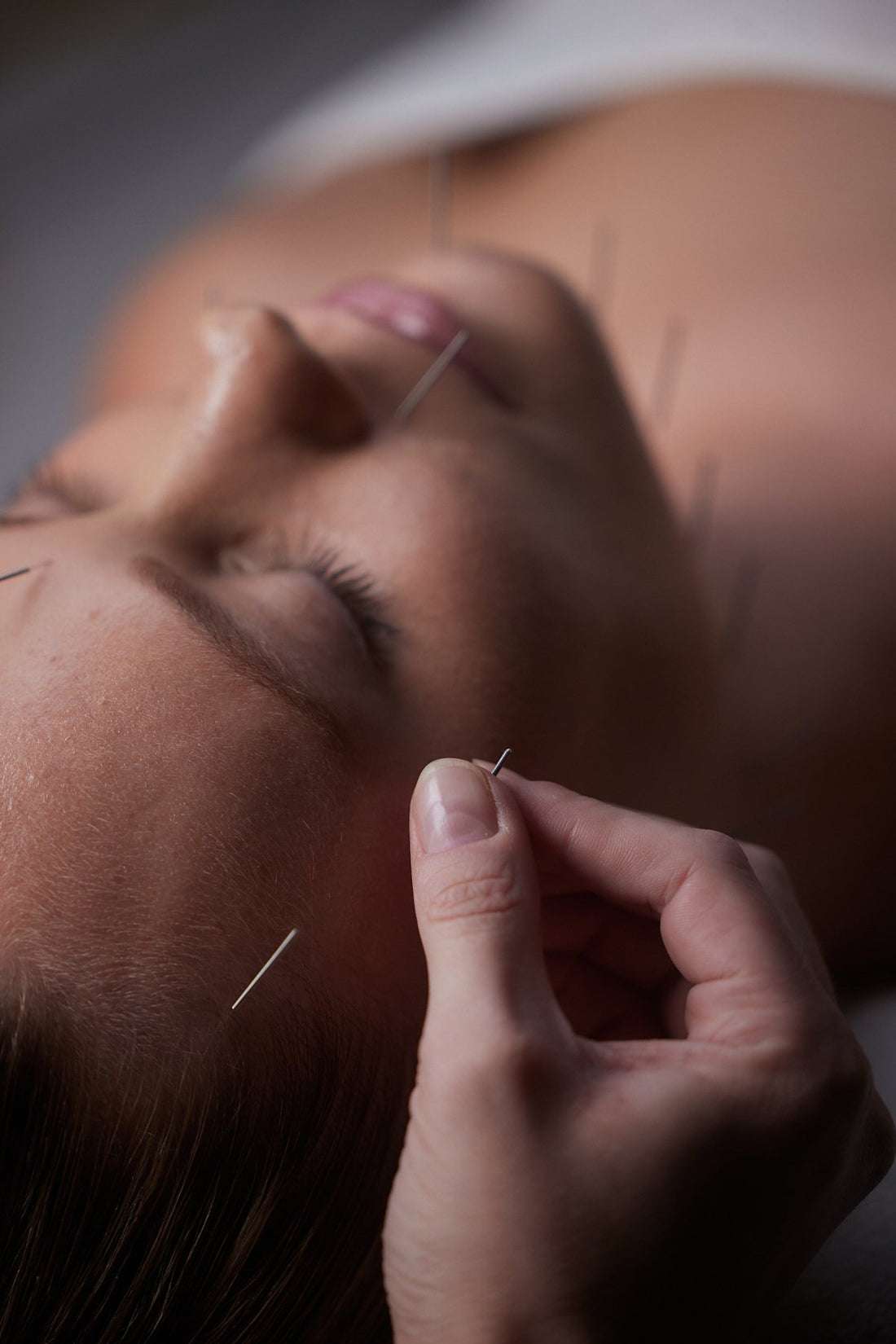 Acupuncture Medicine in South Melbourne: The Modern TCM Guide
