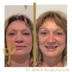 cosmetic acupuncture before and after photos - best acupuncture melbourne