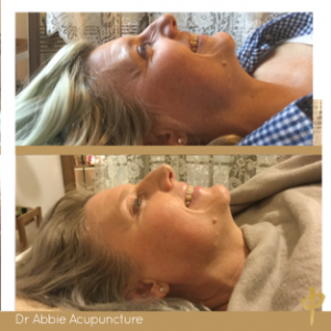 acupuncture before and after - melbourne cosmetic acupuncture clinic
