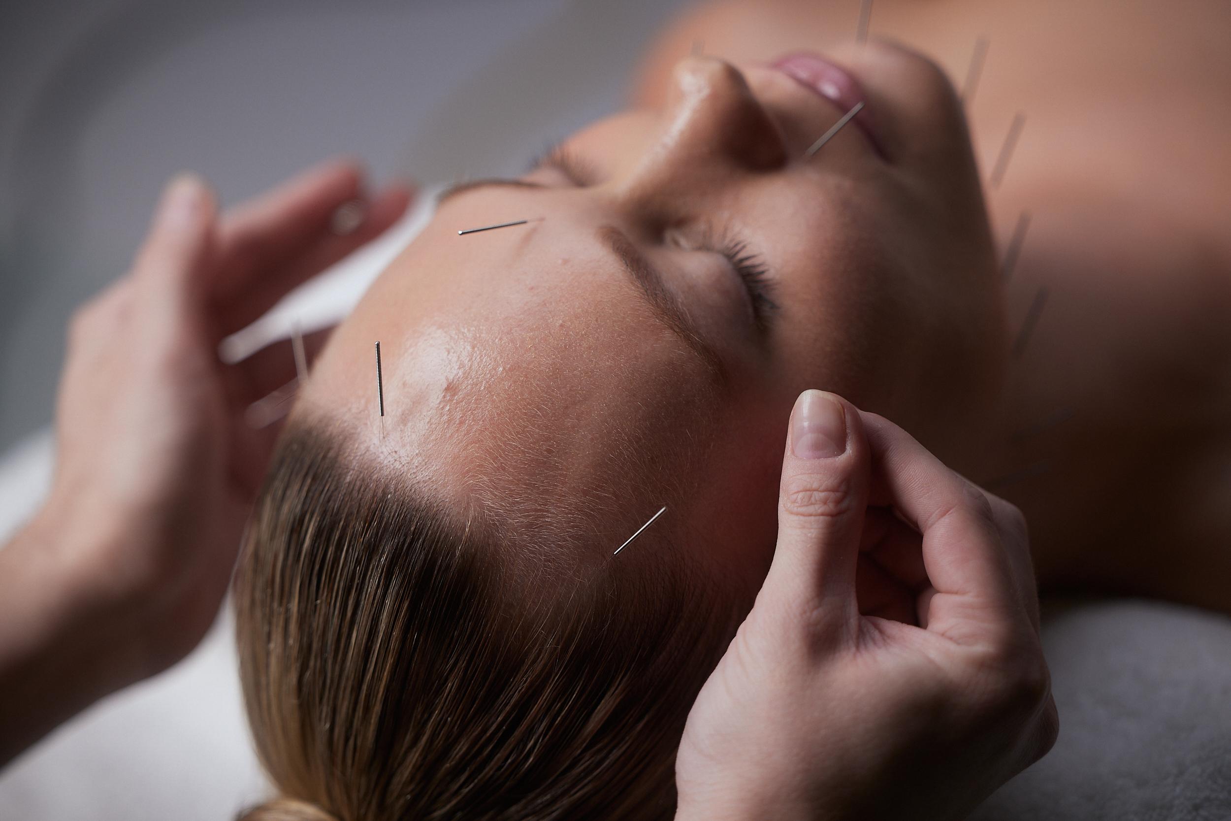 Cosmetic Acupuncture Melbourne