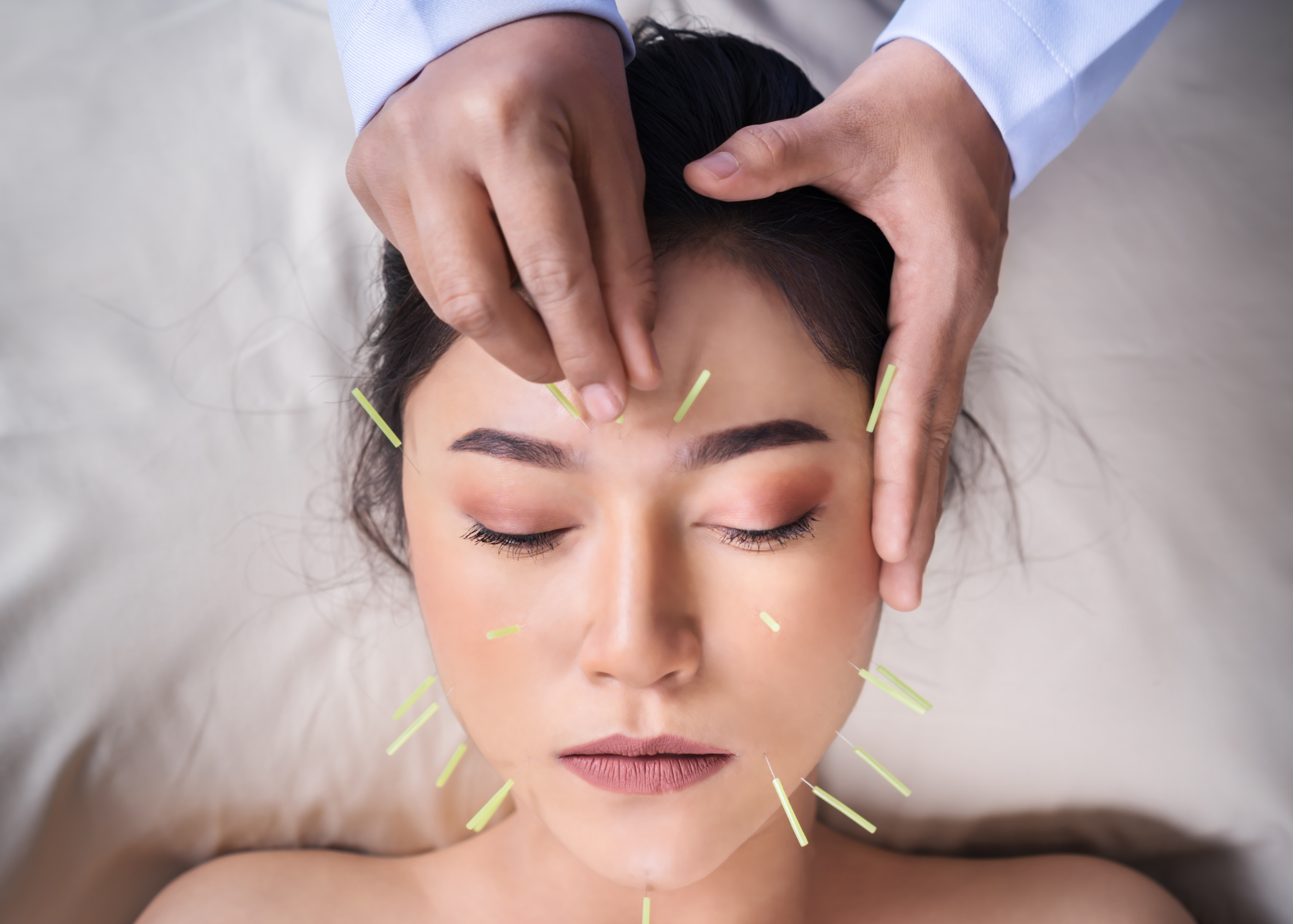 Transform Your Look Naturally: Discover the Best Cosmetic Acupuncture Near You